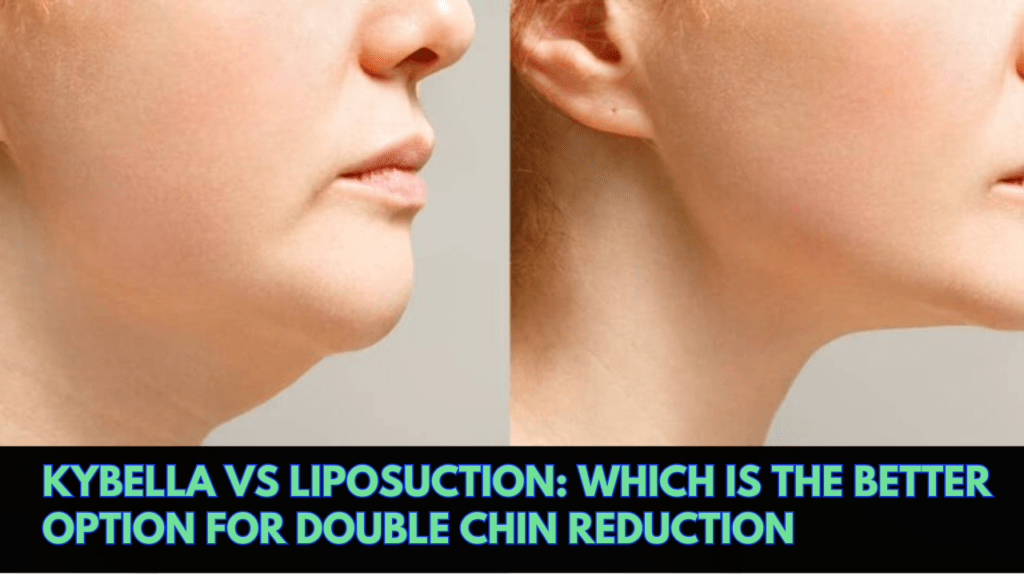 Kybella vs Liposuction