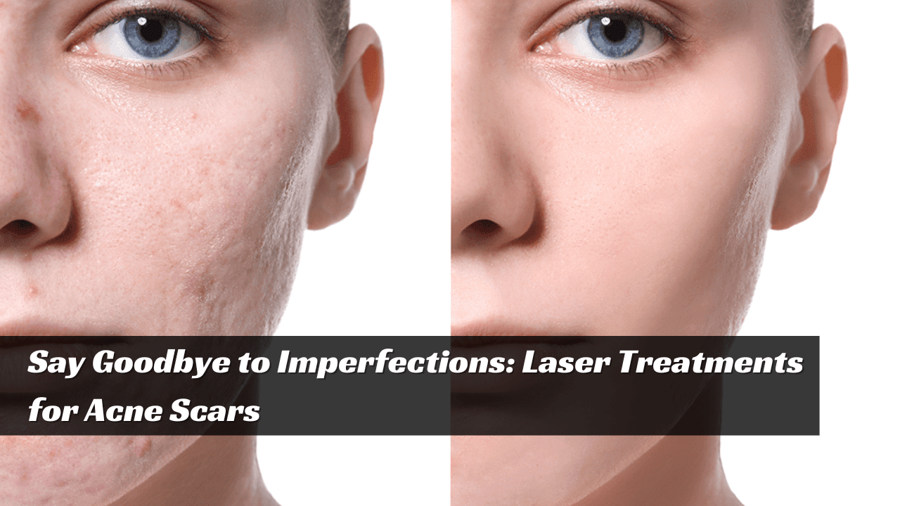 Laser Treatments for Acne Scars