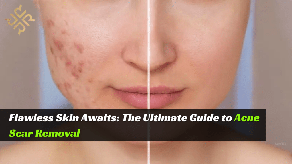 acne scar removal